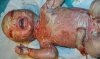 Harlequin-Ichthyosis-in-infants.jpg